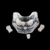 PB-5 Implant Crown and Bridge Combination Kit