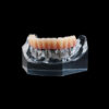 PB-6 Implant Supported Hybrid Denture Kit